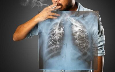 AI tool predicts lung cancer risk in nonsmokers 6 years out | Fierce Biotech